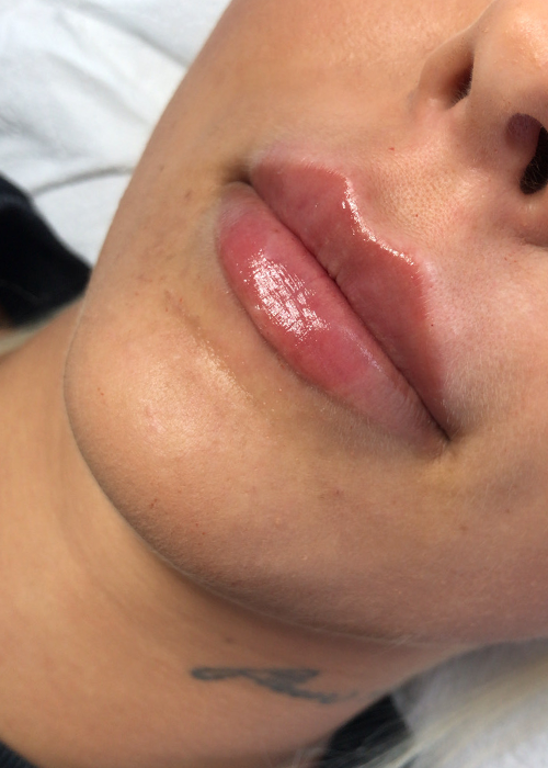 Zdjęcie po zabiegu powiększania ust.