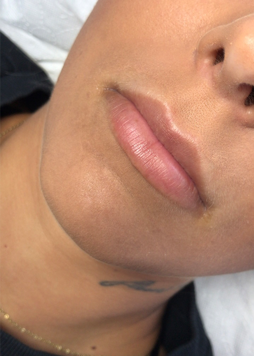 Zdjęcie przed zabiegiem powiększania ust.