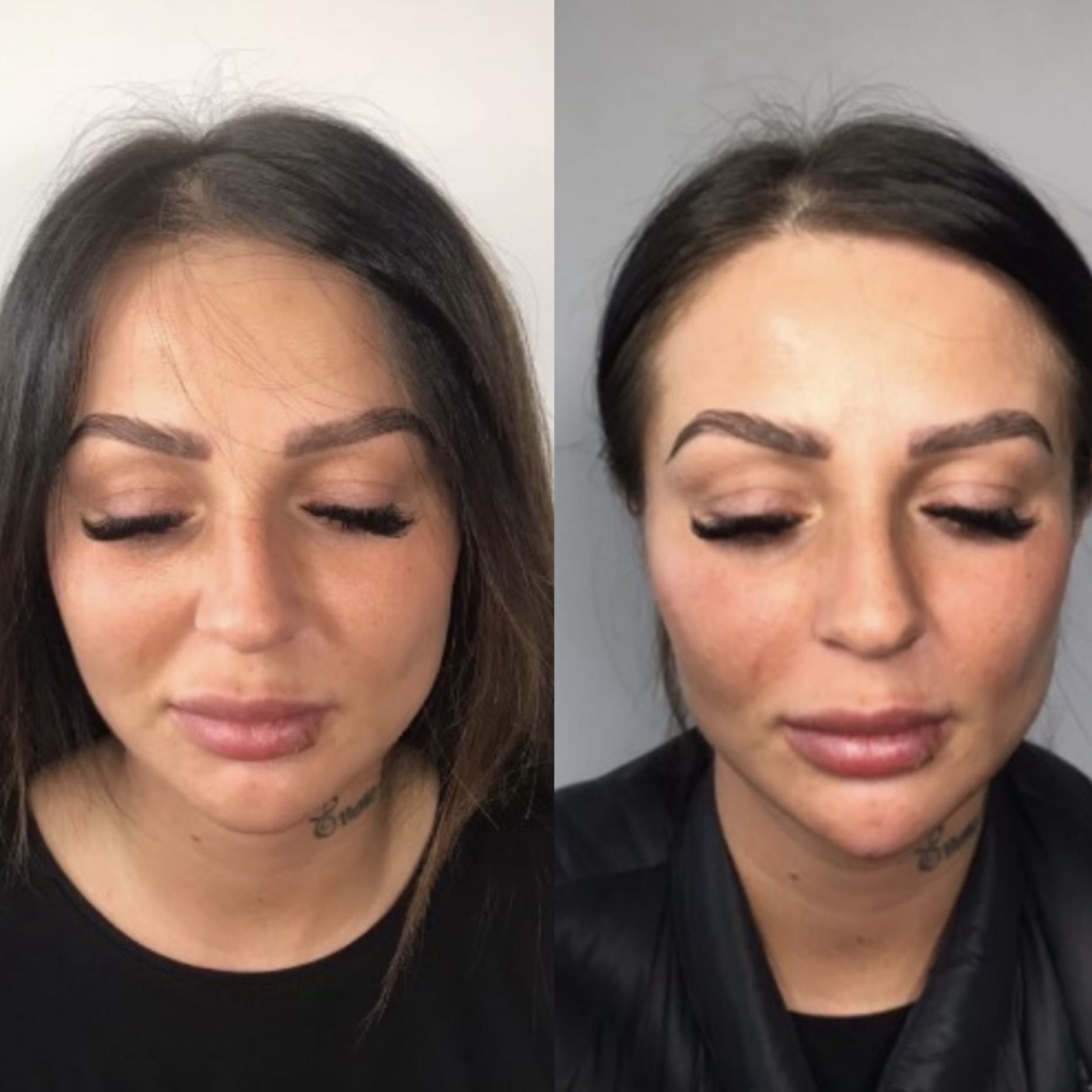 WOLUMETRIA TWARZY (broda, policzki, żuchwa)