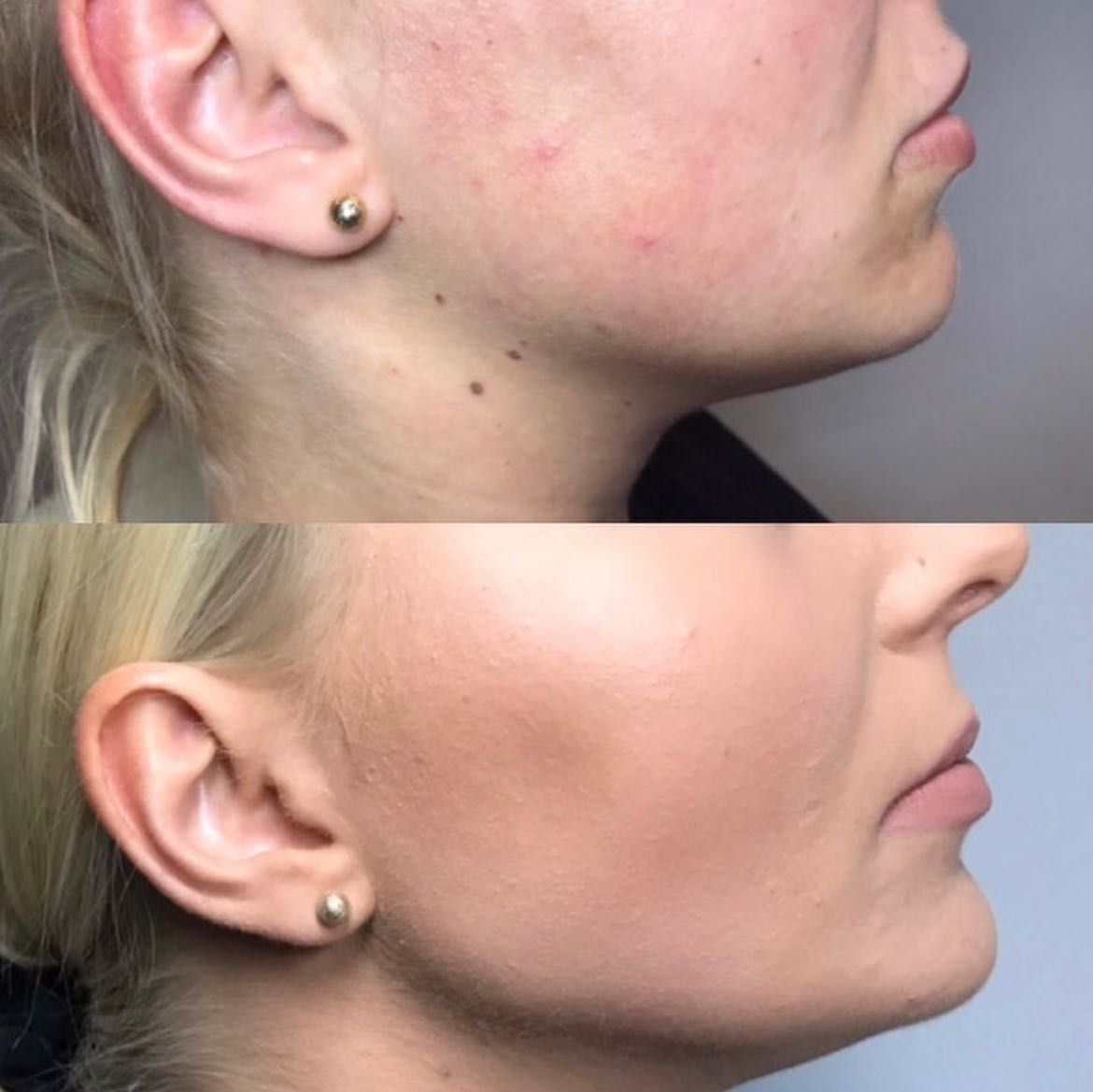 WOLUMETRIA TWARZY (broda, policzki, żuchwa)