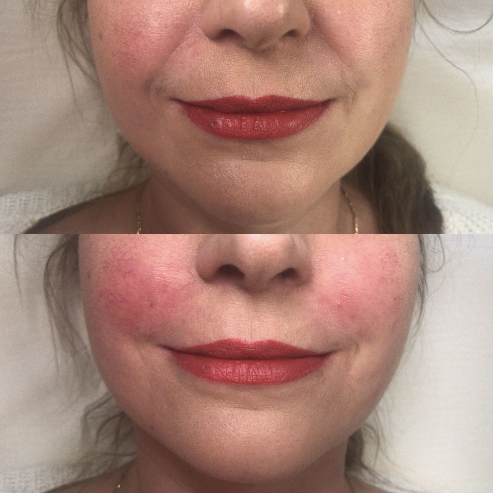 Wypełnianie bruzd nosowo-wargowych