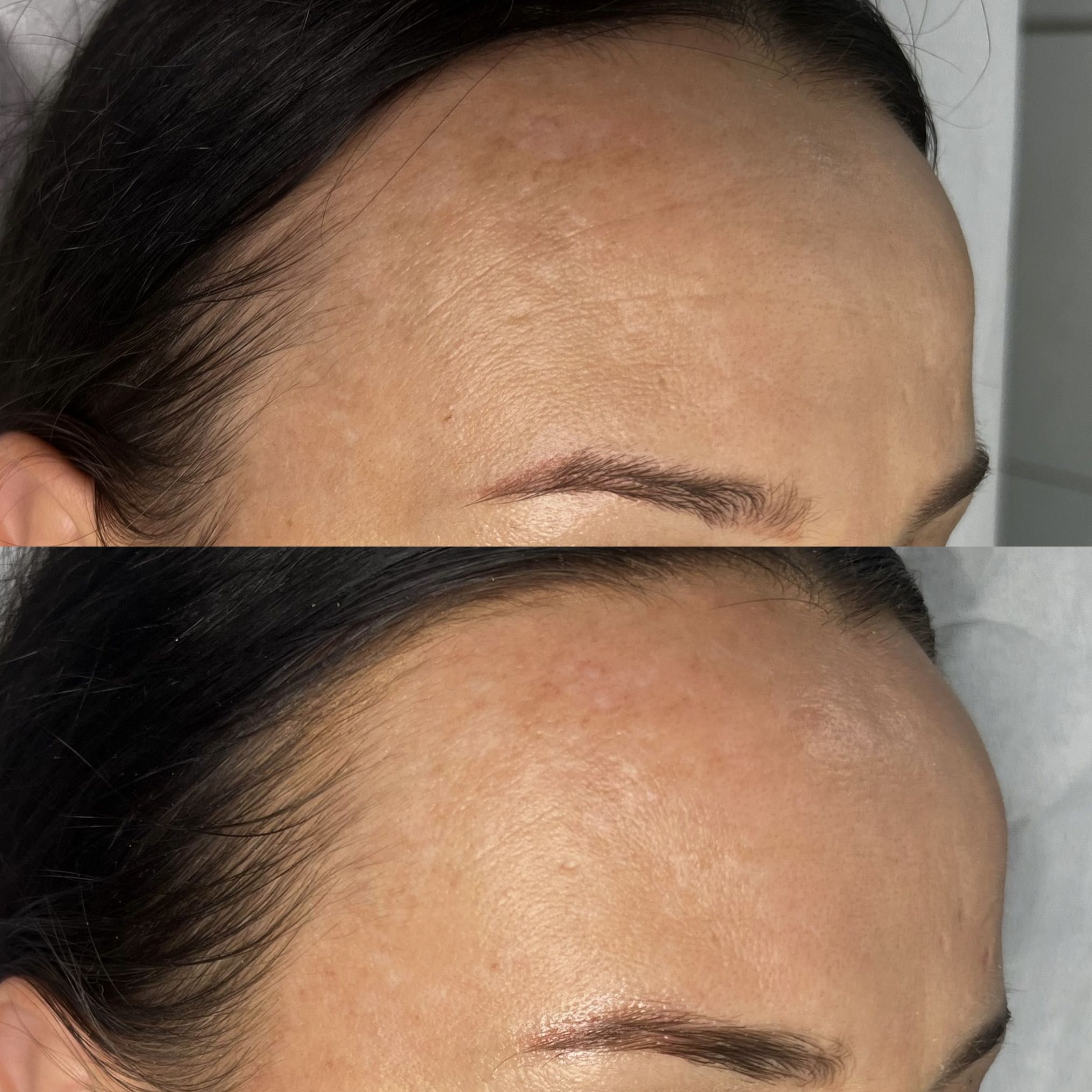 Mezoterapia mikroigłowa depigmentacyjna